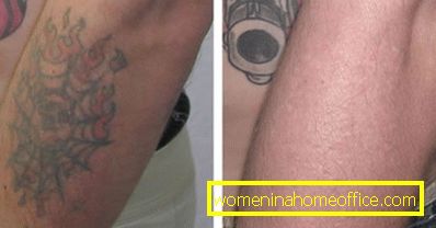 Tattoo removal: means and methods