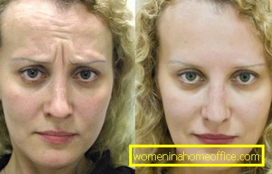 Botox before and after: photo
