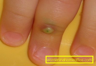 Wart on a finger: photo