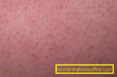 Keratosis of the skin. Symptoms, treatment and possible effects of keratosis