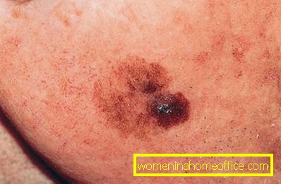 Skin keratosis: photo