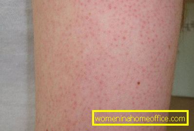 Skin keratosis: photo