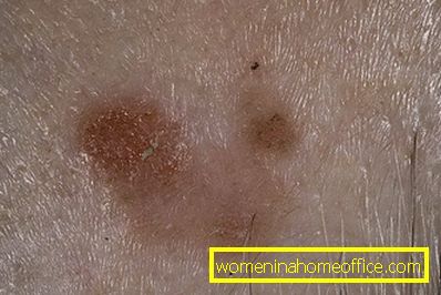 Skin keratosis: treatment