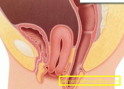 Symptoms of uterine prolapse